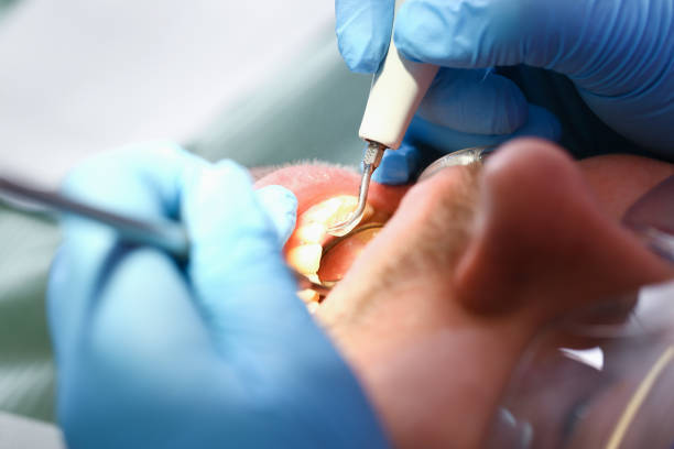 Best Emergency Tooth Extraction in New Berlinville, PA