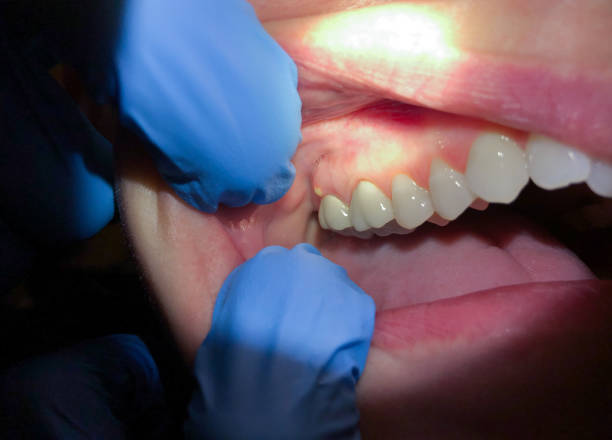 Best Emergency Tooth Extraction in New Berlinville, PA